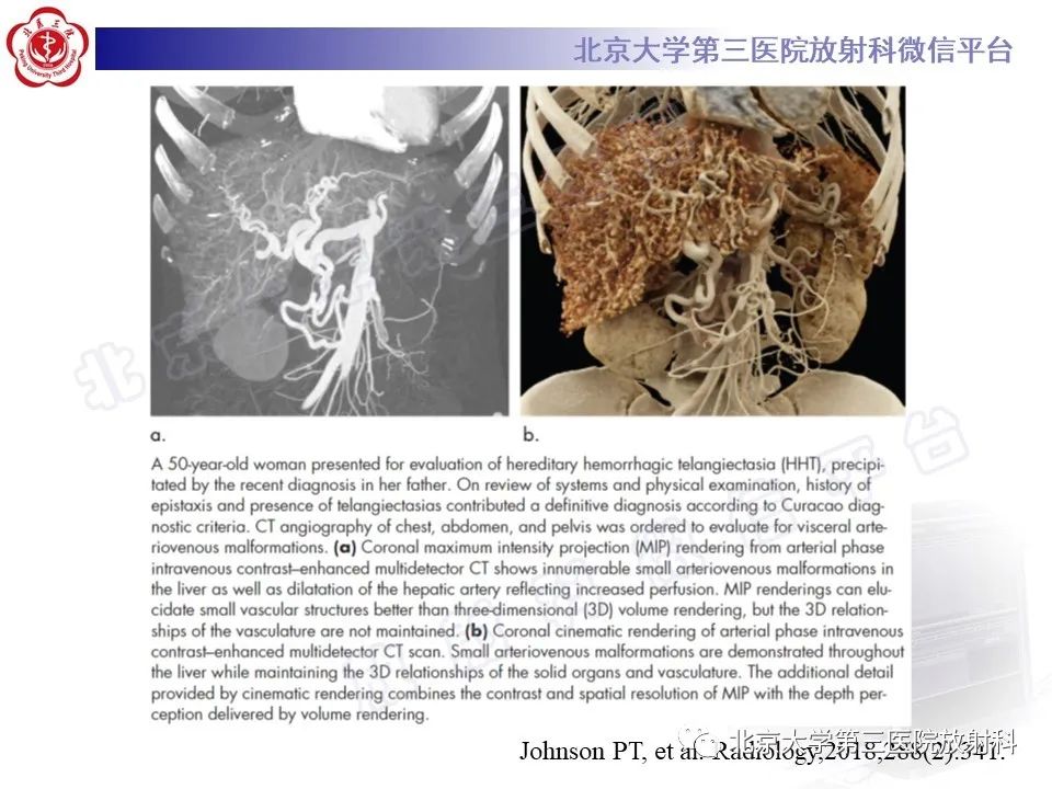 影像PPT - 【PPT】肝脏遗传性出血性毛细血管扩张症-24