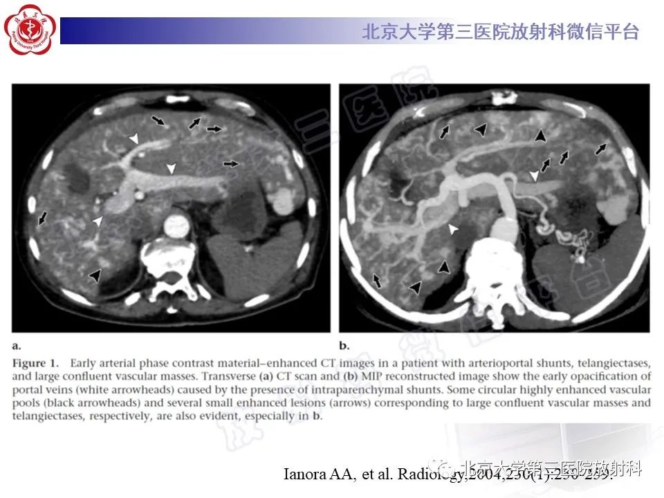 影像PPT - 【PPT】肝脏遗传性出血性毛细血管扩张症-25