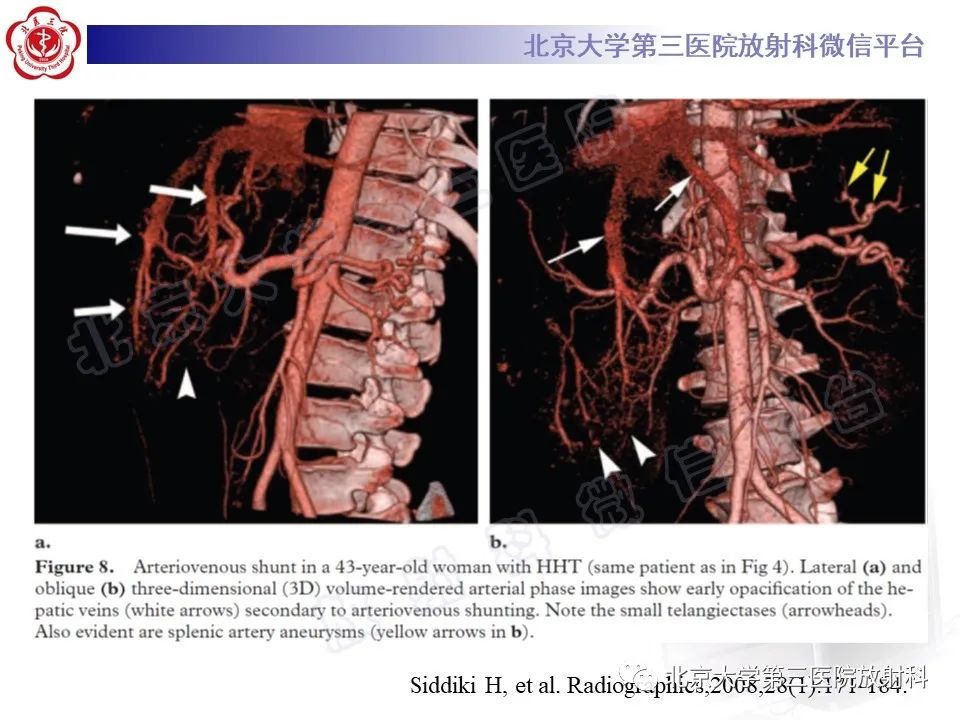 影像PPT - 【PPT】肝脏遗传性出血性毛细血管扩张症-27