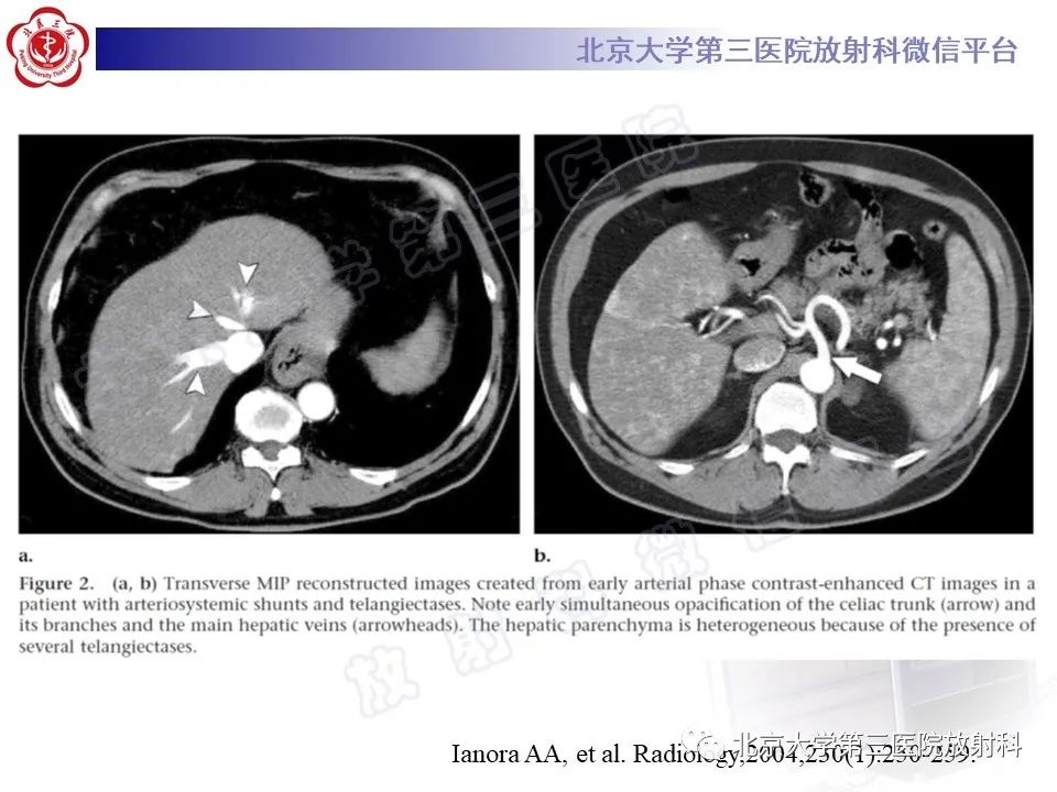 影像PPT - 【PPT】肝脏遗传性出血性毛细血管扩张症-26
