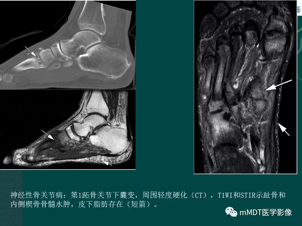 影像PPT - 【PPT】磁共振新技术鉴别糖尿病足的神经性骨关节病和骨髓炎-26