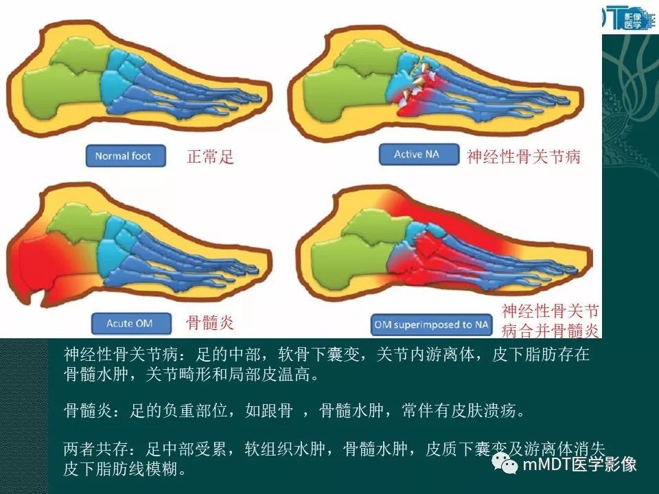 影像PPT - 【PPT】磁共振新技术鉴别糖尿病足的神经性骨关节病和骨髓炎-27