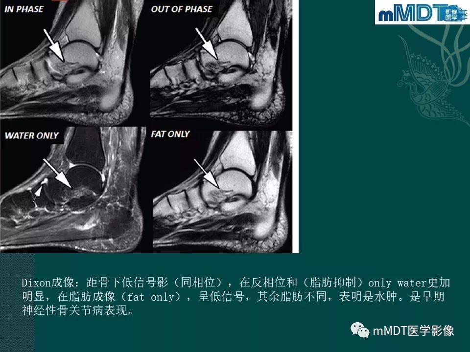 影像PPT - 【PPT】磁共振新技术鉴别糖尿病足的神经性骨关节病和骨髓炎-29