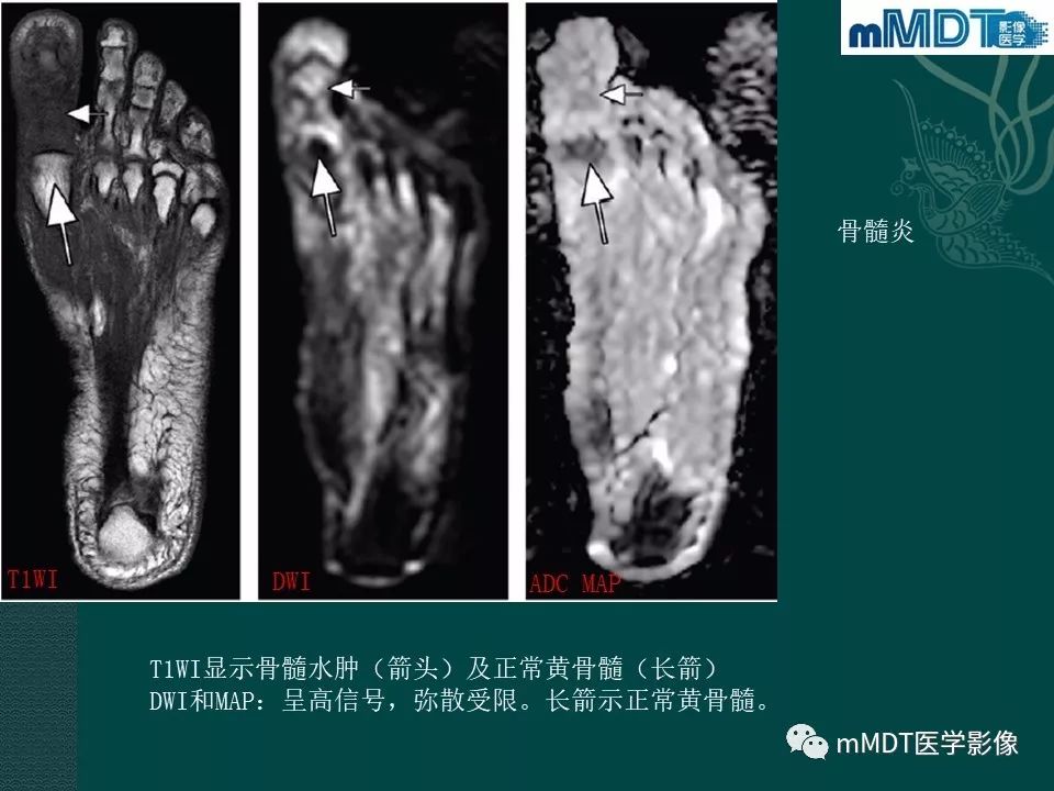 影像PPT - 【PPT】磁共振新技术鉴别糖尿病足的神经性骨关节病和骨髓炎-30