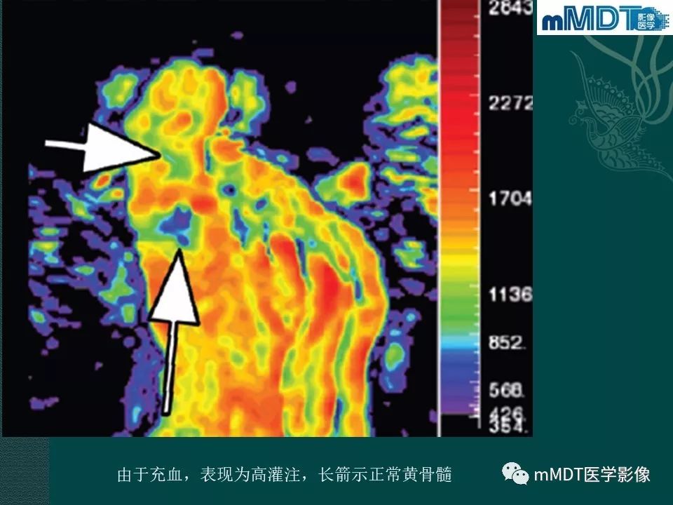 影像PPT - 【PPT】磁共振新技术鉴别糖尿病足的神经性骨关节病和骨髓炎-31