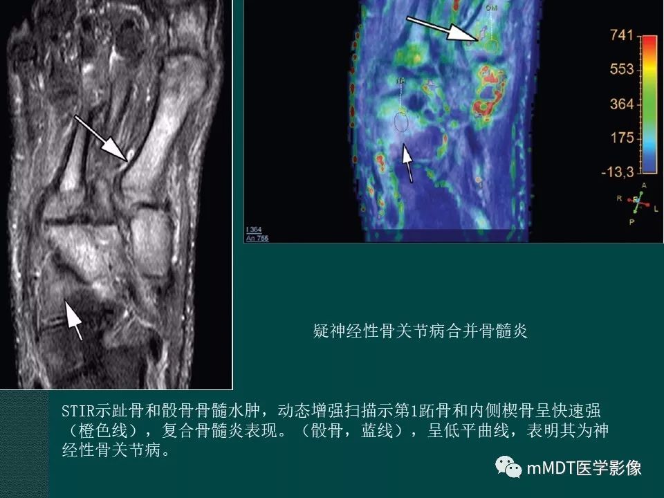 影像PPT - 【PPT】磁共振新技术鉴别糖尿病足的神经性骨关节病和骨髓炎-32