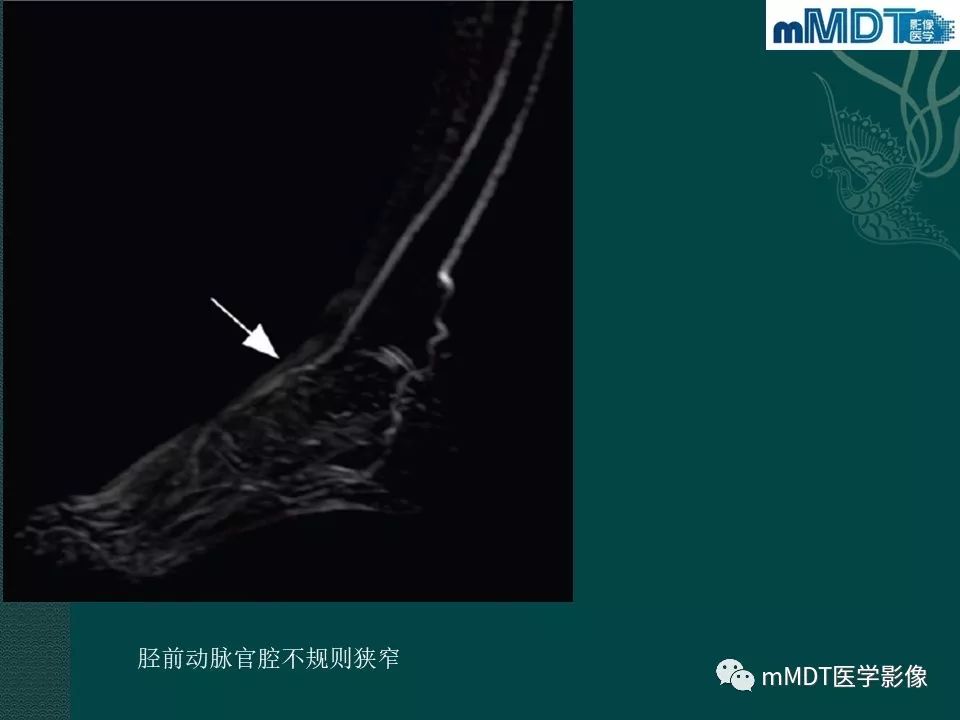 影像PPT - 【PPT】磁共振新技术鉴别糖尿病足的神经性骨关节病和骨髓炎-34