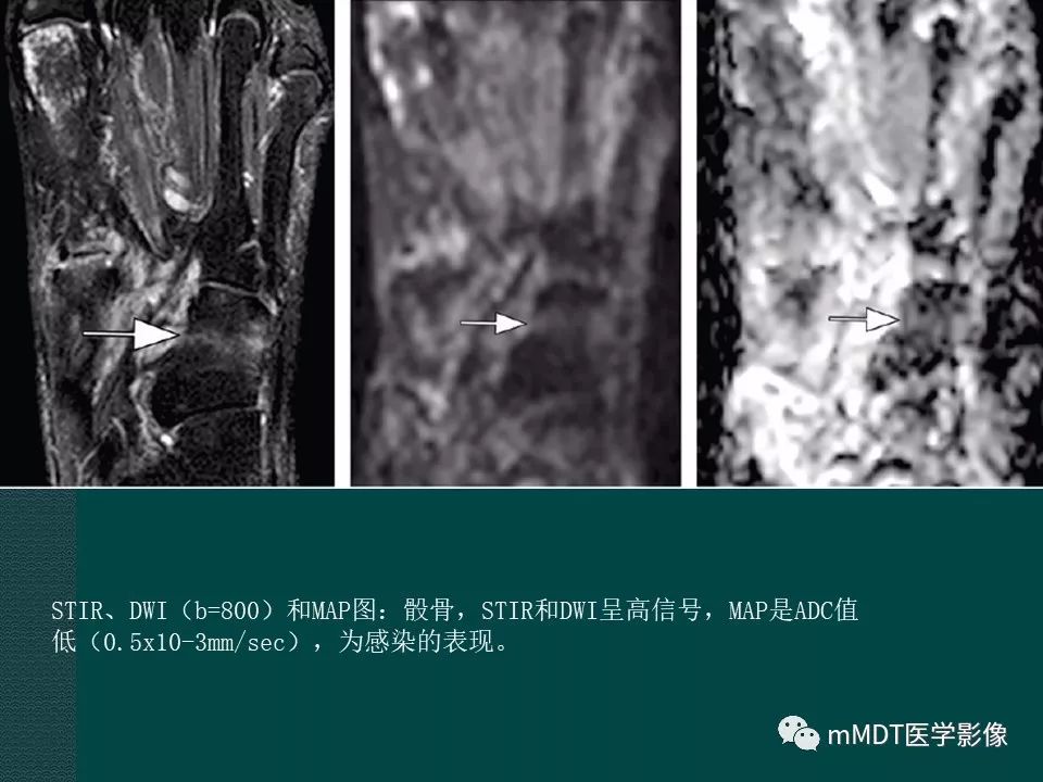 影像PPT - 【PPT】磁共振新技术鉴别糖尿病足的神经性骨关节病和骨髓炎-36