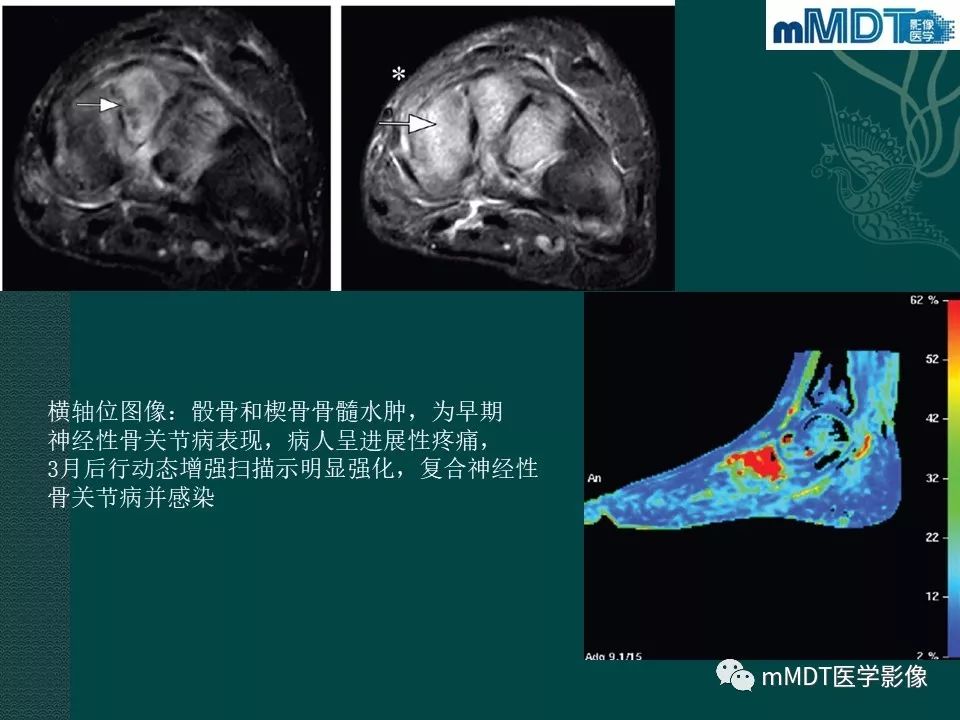 影像PPT - 【PPT】磁共振新技术鉴别糖尿病足的神经性骨关节病和骨髓炎-37