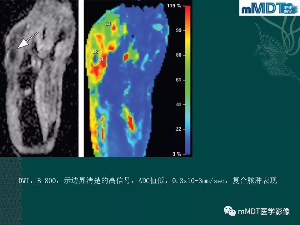 影像PPT - 【PPT】磁共振新技术鉴别糖尿病足的神经性骨关节病和骨髓炎-39