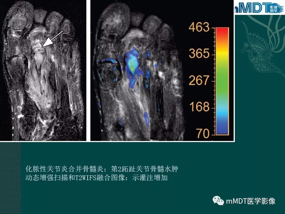 影像PPT - 【PPT】磁共振新技术鉴别糖尿病足的神经性骨关节病和骨髓炎-41