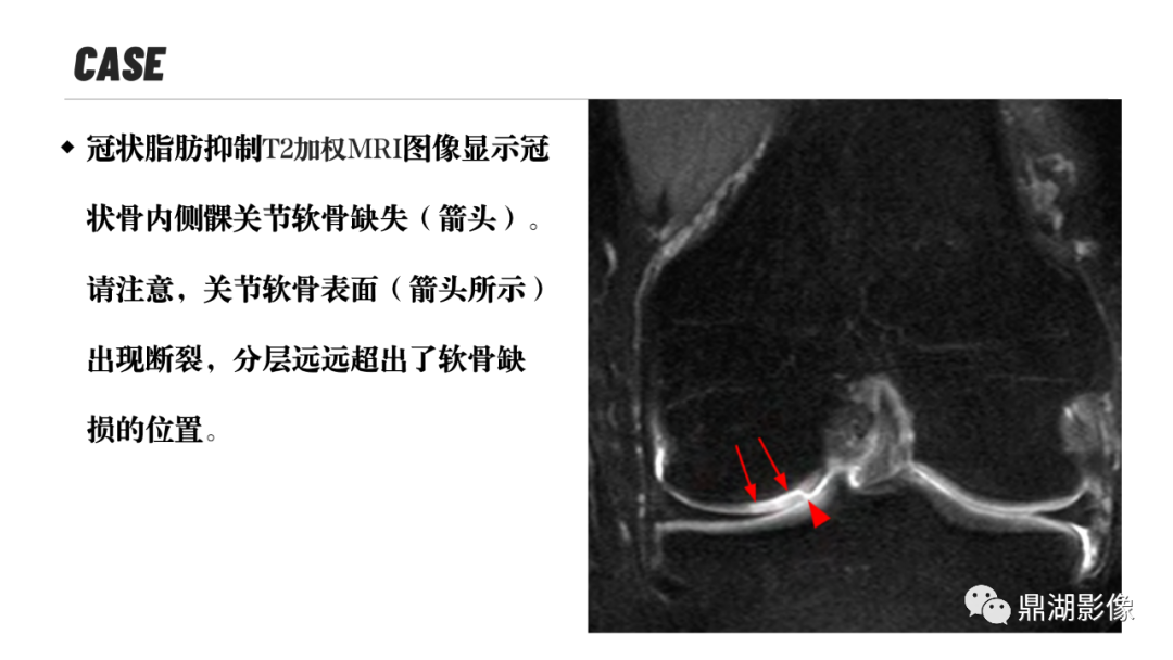 影像PPT - 【PPT】MR诊断骨关节里的组织分层-11 影像PPT - 【PPT】MR诊断骨关节里的组织分层-11