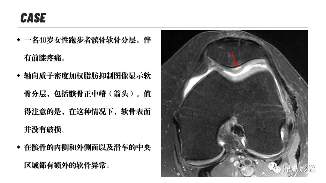 影像PPT - 【PPT】MR诊断骨关节里的组织分层-12 影像PPT - 【PPT】MR诊断骨关节里的组织分层-12