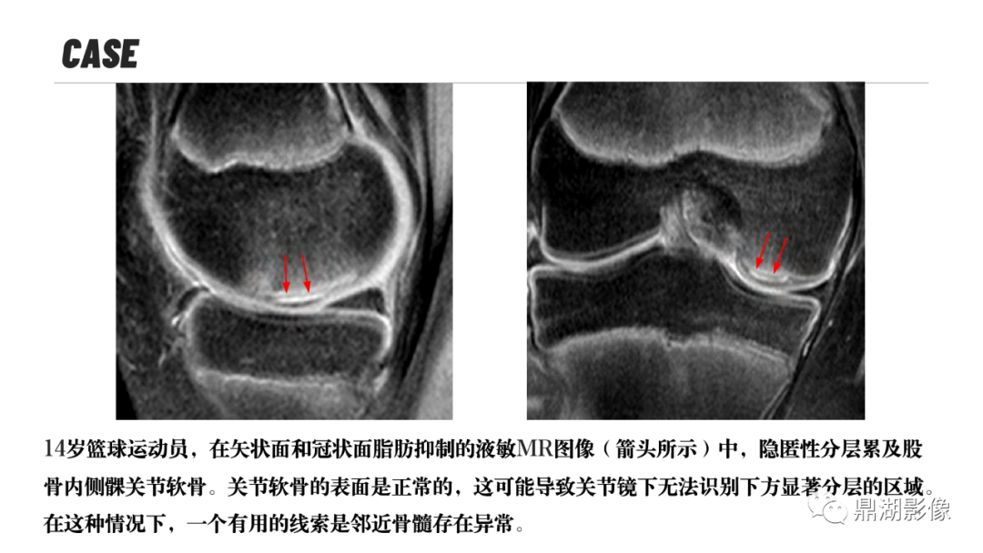 影像PPT - 【PPT】MR诊断骨关节里的组织分层-13 影像PPT - 【PPT】MR诊断骨关节里的组织分层-13