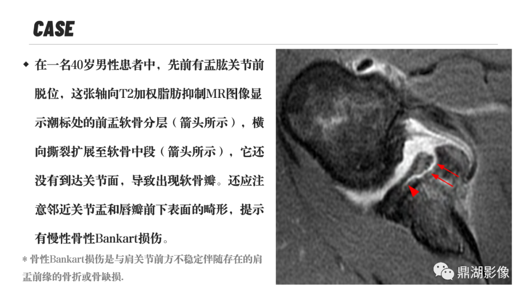影像PPT - 【PPT】MR诊断骨关节里的组织分层-14 影像PPT - 【PPT】MR诊断骨关节里的组织分层-14