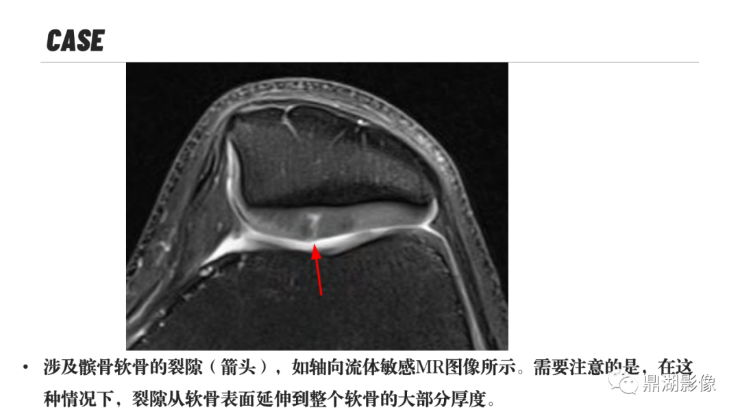 影像PPT - 【PPT】MR诊断骨关节里的组织分层-17 影像PPT - 【PPT】MR诊断骨关节里的组织分层-17