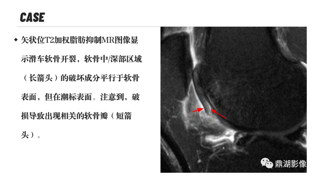 影像PPT - 【PPT】MR诊断骨关节里的组织分层-22 影像PPT - 【PPT】MR诊断骨关节里的组织分层-22