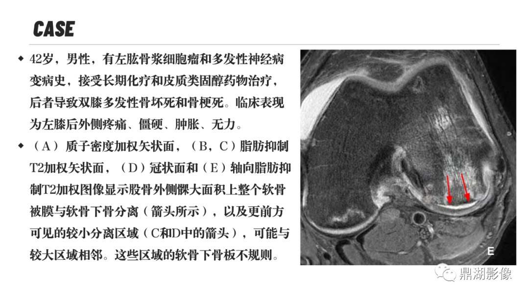 影像PPT - 【PPT】MR诊断骨关节里的组织分层-26 影像PPT - 【PPT】MR诊断骨关节里的组织分层-26