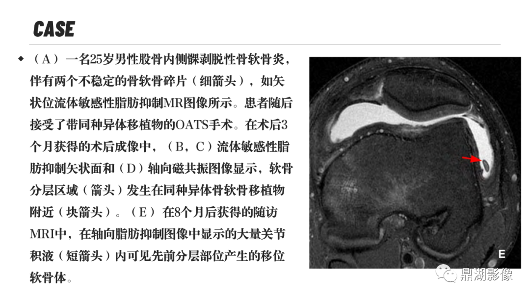 影像PPT - 【PPT】MR诊断骨关节里的组织分层-32 影像PPT - 【PPT】MR诊断骨关节里的组织分层-32
