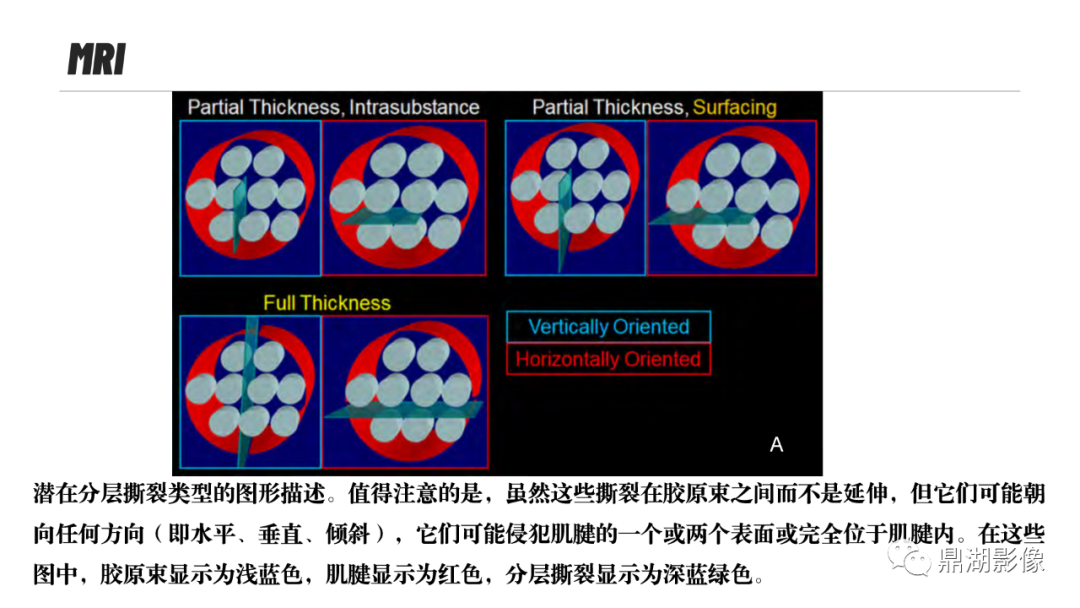 影像PPT - 【PPT】MR诊断骨关节里的组织分层-36 影像PPT - 【PPT】MR诊断骨关节里的组织分层-36