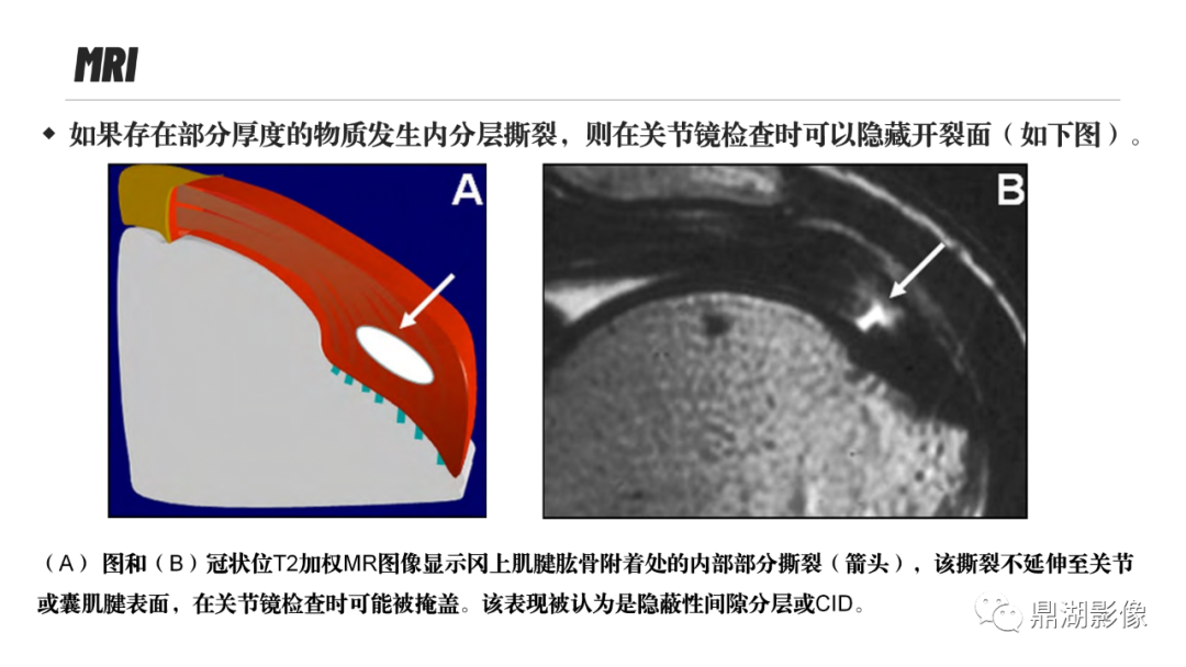 影像PPT - 【PPT】MR诊断骨关节里的组织分层-41 影像PPT - 【PPT】MR诊断骨关节里的组织分层-41