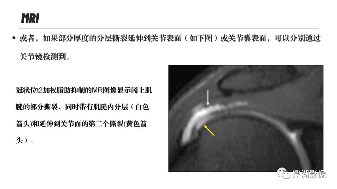 影像PPT - 【PPT】MR诊断骨关节里的组织分层-42 影像PPT - 【PPT】MR诊断骨关节里的组织分层-42