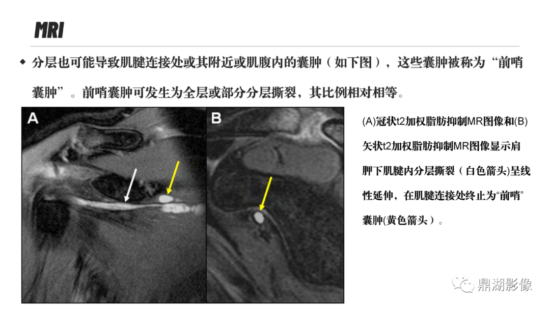 影像PPT - 【PPT】MR诊断骨关节里的组织分层-43 影像PPT - 【PPT】MR诊断骨关节里的组织分层-43