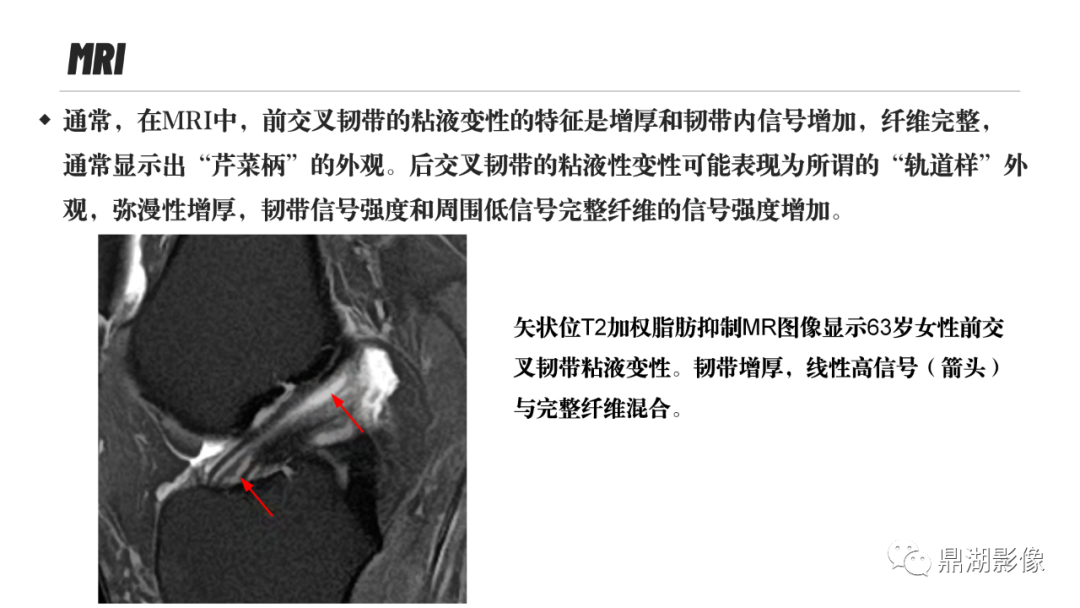 影像PPT - 【PPT】MR诊断骨关节里的组织分层-51 影像PPT - 【PPT】MR诊断骨关节里的组织分层-51