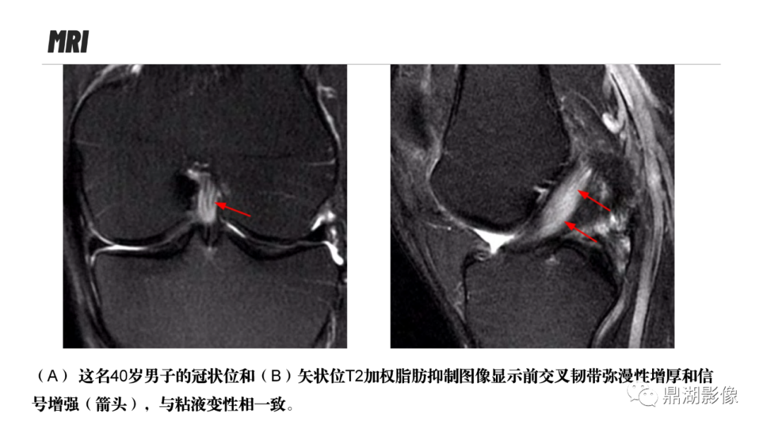 影像PPT - 【PPT】MR诊断骨关节里的组织分层-52 影像PPT - 【PPT】MR诊断骨关节里的组织分层-52