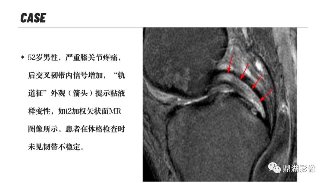 影像PPT - 【PPT】MR诊断骨关节里的组织分层-56 影像PPT - 【PPT】MR诊断骨关节里的组织分层-56