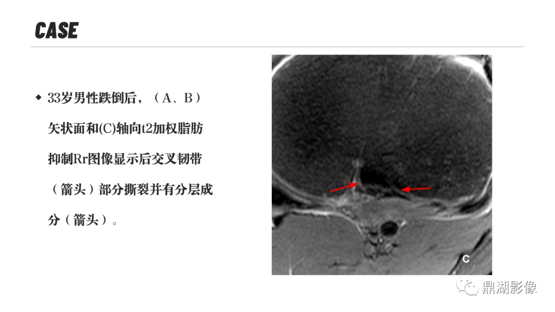 影像PPT - 【PPT】MR诊断骨关节里的组织分层-60 影像PPT - 【PPT】MR诊断骨关节里的组织分层-60