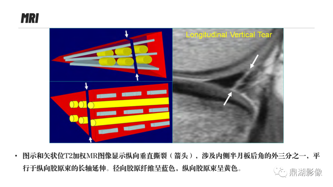 影像PPT - 【PPT】MR诊断骨关节里的组织分层-67 影像PPT - 【PPT】MR诊断骨关节里的组织分层-67