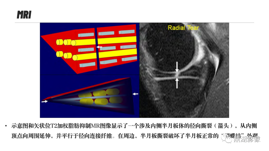 影像PPT - 【PPT】MR诊断骨关节里的组织分层-71 影像PPT - 【PPT】MR诊断骨关节里的组织分层-71