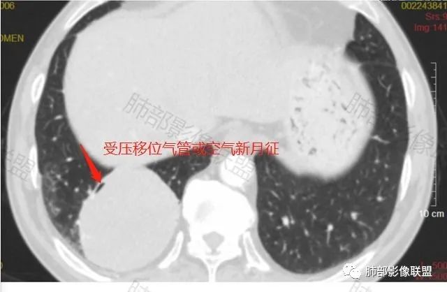 影像PPT - 【病例】PSP与类癌之辩-44