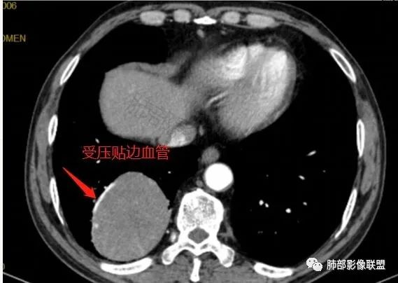 影像PPT - 【病例】PSP与类癌之辩-45