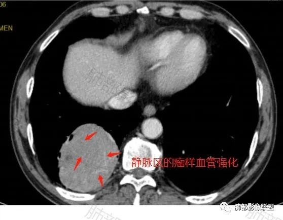 影像PPT - 【病例】PSP与类癌之辩-46