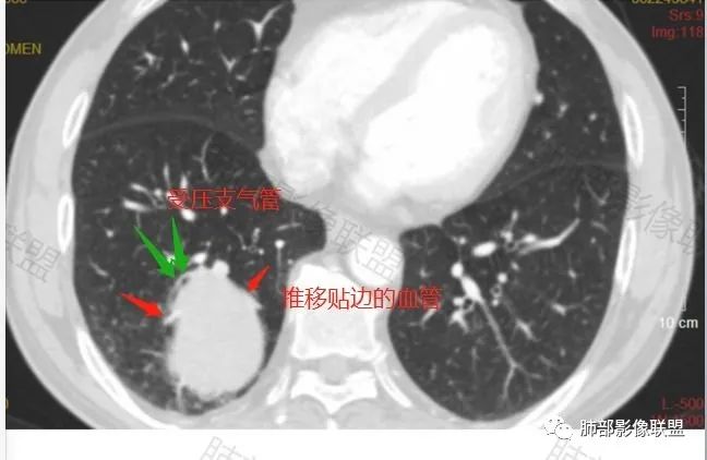 影像PPT - 【病例】PSP与类癌之辩-47