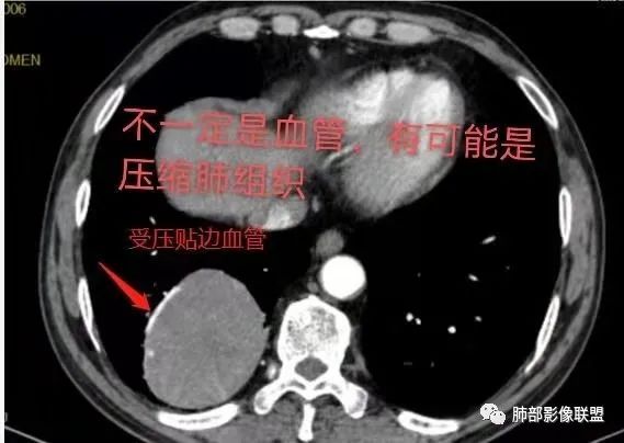 影像PPT - 【病例】PSP与类癌之辩-48