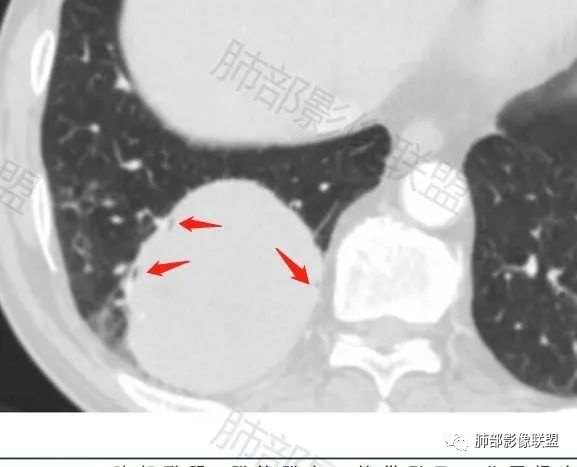 影像PPT - 【病例】PSP与类癌之辩-53