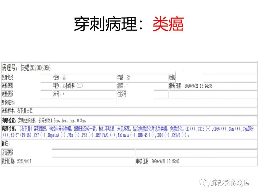 影像PPT - 【病例】PSP与类癌之辩-59