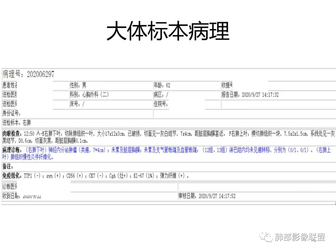 影像PPT - 【病例】PSP与类癌之辩-60