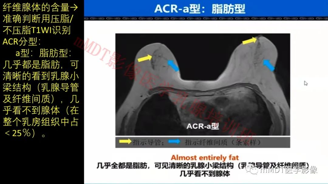 影像PPT - 【PPT】乳腺MRI诊断-8 影像PPT - 【PPT】乳腺MRI诊断-8