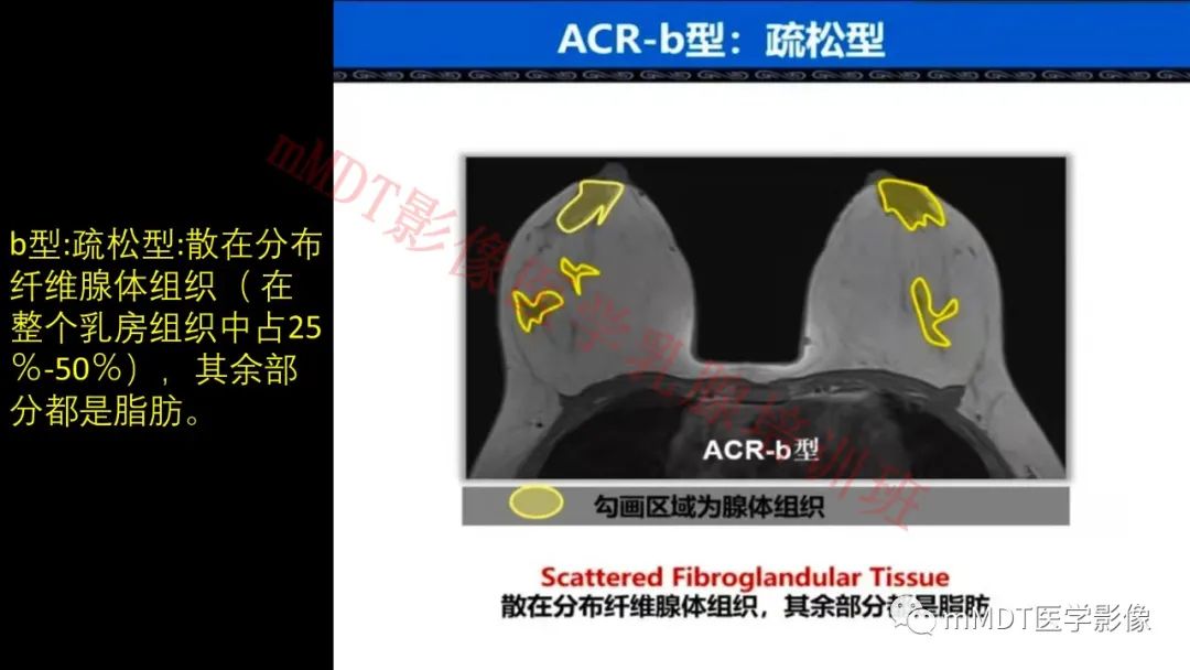 影像PPT - 【PPT】乳腺MRI诊断-9 影像PPT - 【PPT】乳腺MRI诊断-9