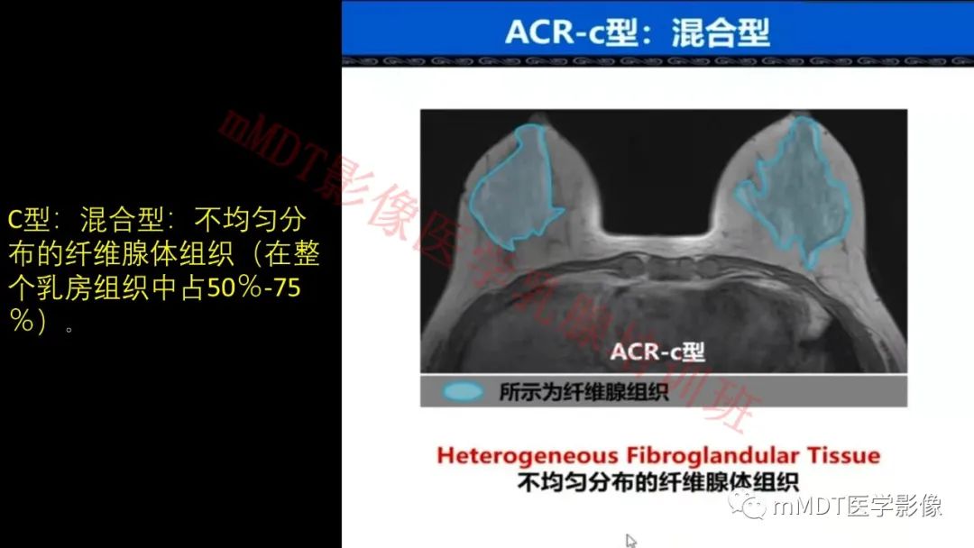 影像PPT - 【PPT】乳腺MRI诊断-10 影像PPT - 【PPT】乳腺MRI诊断-10