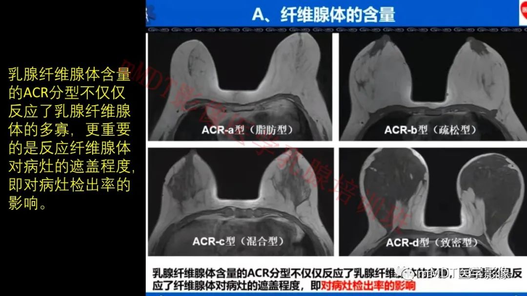 影像PPT - 【PPT】乳腺MRI诊断-12 影像PPT - 【PPT】乳腺MRI诊断-12