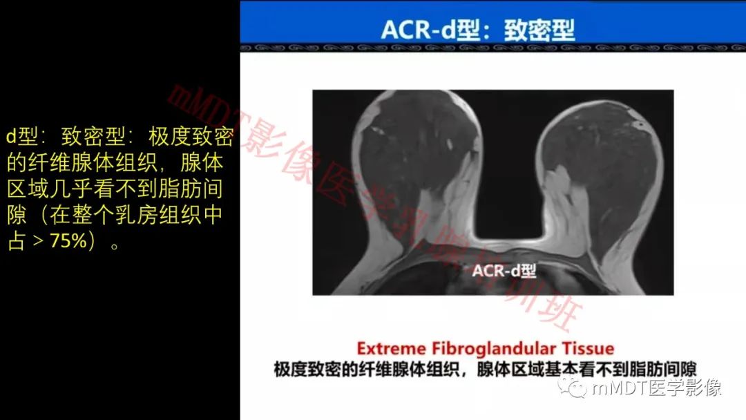 影像PPT - 【PPT】乳腺MRI诊断-11 影像PPT - 【PPT】乳腺MRI诊断-11