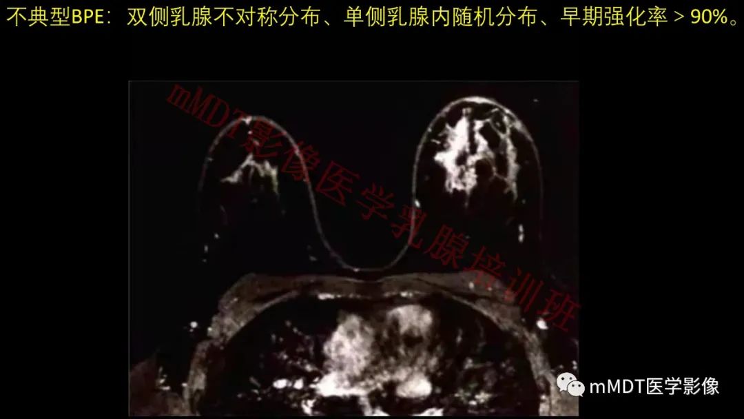 影像PPT - 【PPT】乳腺MRI诊断-18 影像PPT - 【PPT】乳腺MRI诊断-18