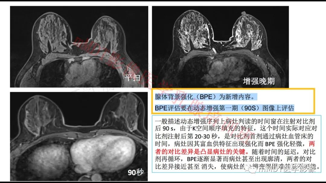 影像PPT - 【PPT】乳腺MRI诊断-20 影像PPT - 【PPT】乳腺MRI诊断-20