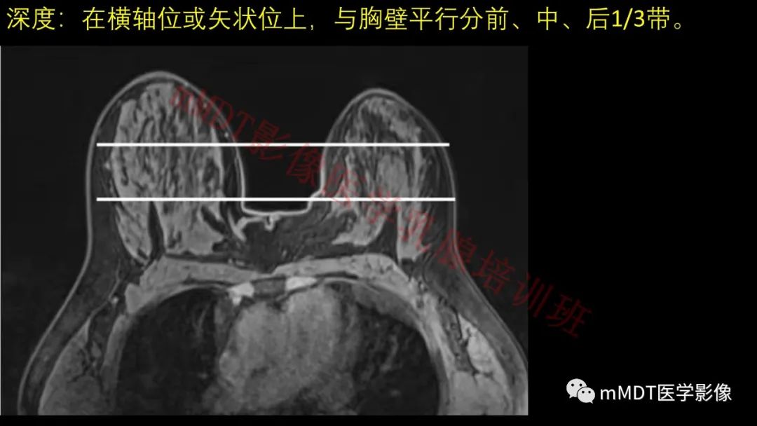 影像PPT - 【PPT】乳腺MRI诊断-27 影像PPT - 【PPT】乳腺MRI诊断-27