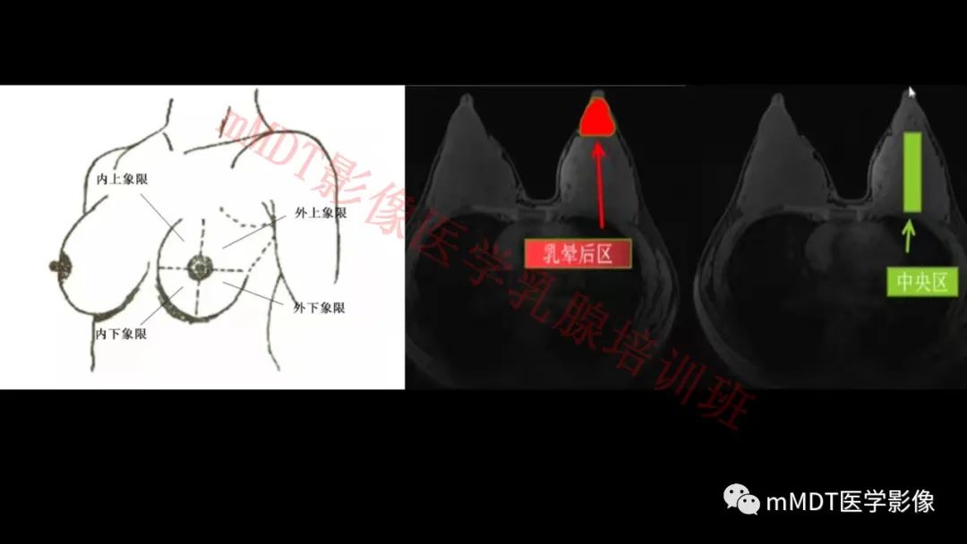 影像PPT - 【PPT】乳腺MRI诊断-26 影像PPT - 【PPT】乳腺MRI诊断-26
